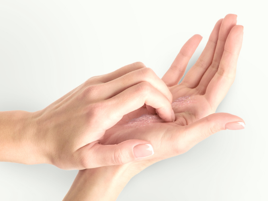 Waspada Dermatitis Kontak akibat Penggunaan Hand Sanitizer!